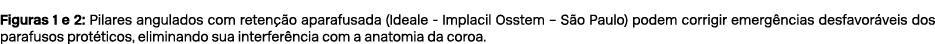 Figuras 1 e 2: Pilares angulados com reten o aparafusada (Ideale Implacil Osstem – S o Paulo) podem corrigir emerg n...