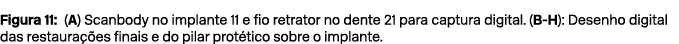 Figura 11: (A) Scanbody no implante 11 e fio retrator no dente 21 para captura digital. (B H): Desenho digital das re...
