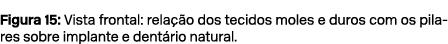 Figura 15: Vista frontal: rela o dos tecidos moles e duros com os pilares sobre implante e dent rio natural.