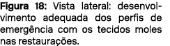 Figura 18: Vista lateral: desenvolvimento adequada dos perfis de emerg ncia com os tecidos moles nas restaura es.
