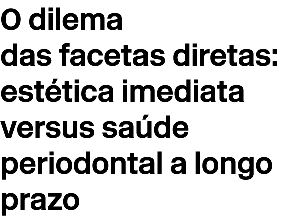 O dilema das facetas diretas: est tica imediata versus sa de periodontal a longo prazo