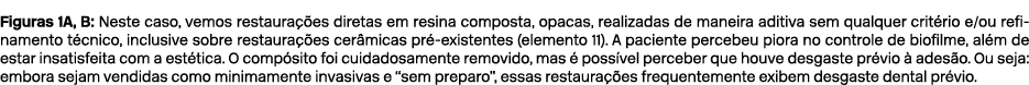 Figuras 1A, B: Neste caso, vemos restaura es diretas em resina composta, opacas, realizadas de maneira aditiva sem q...