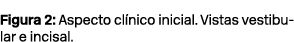 Figura 2: Aspecto cl nico inicial. Vistas vestibular e incisal.