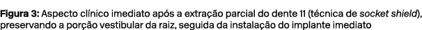 Figura 3: Aspecto cl nico imediato ap s a extra o parcial do dente 11 (t cnica de socket shield), preservando a por ...