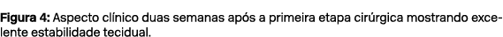 Figura 4: Aspecto cl nico duas semanas ap s a primeira etapa cir rgica mostrando excelente estabilidade tecidual.