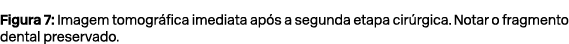 Figura 7: Imagem tomogr fica imediata ap s a segunda etapa cir rgica. Notar o fragmento dental preservado.