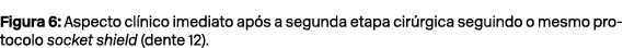 Figura 6: Aspecto cl nico imediato ap s a segunda etapa cir rgica seguindo o mesmo protocolo socket shield (dente 12). 