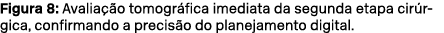 Figura 8: Avalia o tomogr fica imediata da segunda etapa cir rgica, confirmando a precis o do planejamento digital.